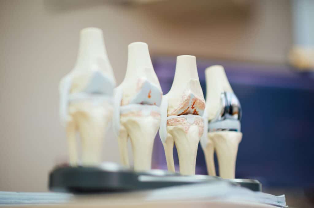 Arthrose du genou : que faire ?